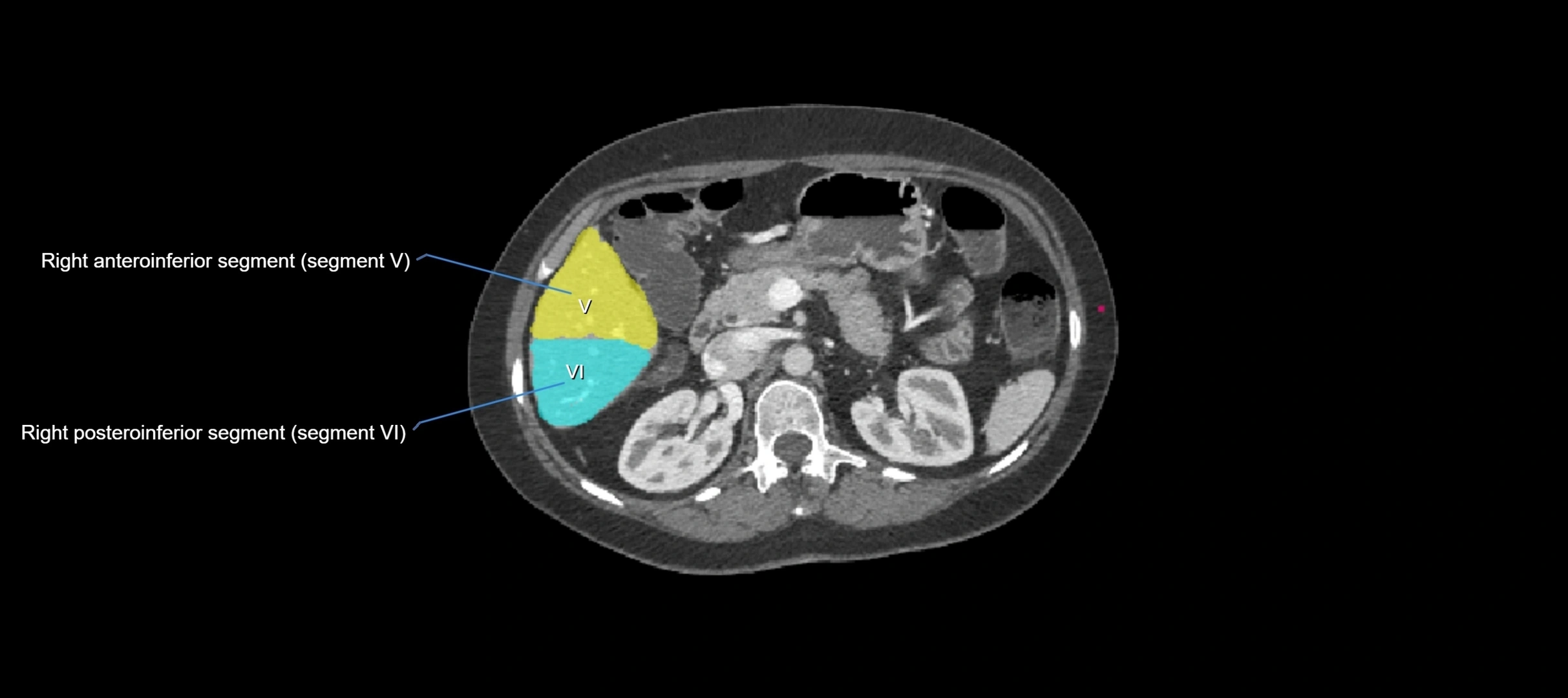 CT liver segments axial cross sectional anatomy labelled image-00030.webp